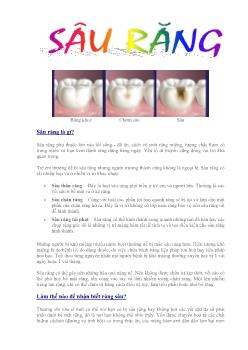 Tìm hiểu về Sâu răng